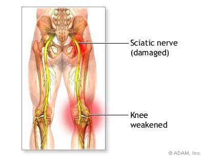 stretches for sciatica. Running down your sciatica is