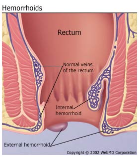 hemorrhoids treatment home remedy
