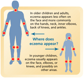 Eczema is a condition - WebMD