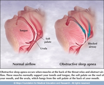 Natural Sleep Apnea Cures 49