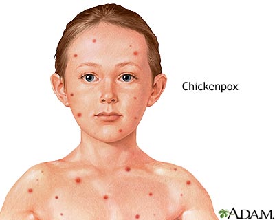  Babies  Diaper Rash on Chicken Pox Pictures Early Stage Of Chicken Pox   Prlog