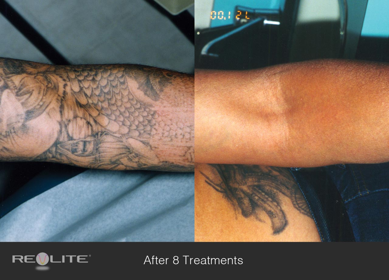 Laser Tattoo Removal - Before and After 8 Treatments