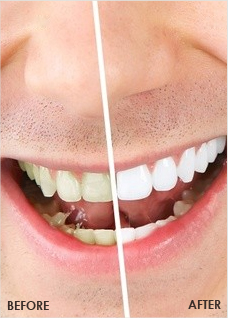  Edge offers deals on in-office teeth bleaching or teeth whitening