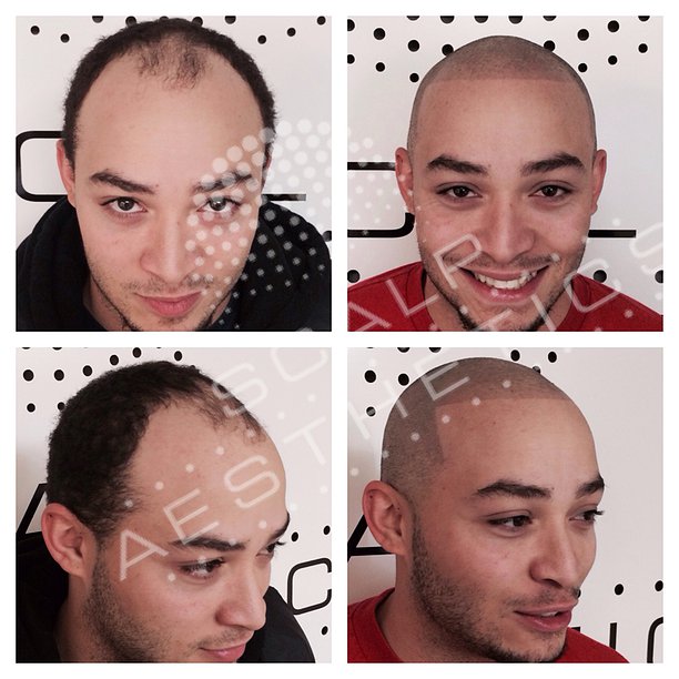 Scalp Micropigmentation: The Truth About SMP Scalp Tattoo Treatments | FinancialContent Business Page Scalp Micropigmentation: The Truth About SMP Scalp Tattoo Treatments | FinancialContent Business Page