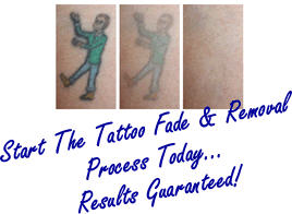 Tattoo Removal