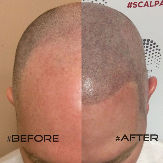 Finding The Best Scalp Micropigmentation Clinic in Toronto 