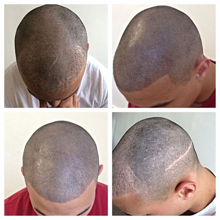 Scalp Micropigmentation