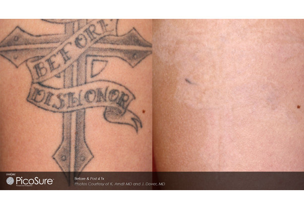 ... Doctor to Remove Tattoos -- Vero Cosmetic Surgery &amp; Medispa | PRLog