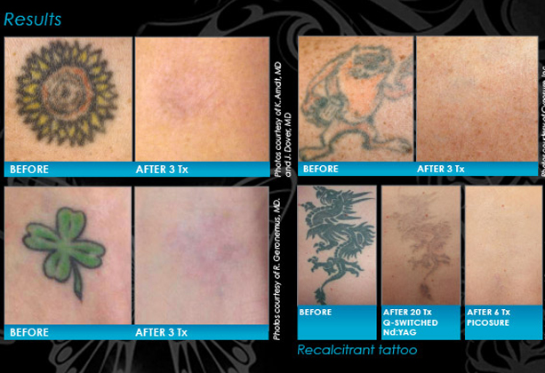 ... Doctor to Remove Tattoos -- Vero Cosmetic Surgery &amp; Medispa | PRLog