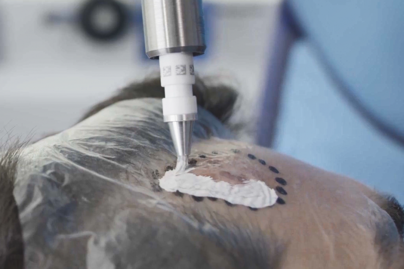 Rhenium-SCT Personalised Treatment On Temple
